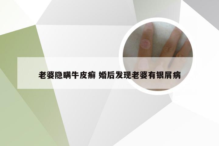 老婆隐瞒牛皮癣 婚后发现老婆有银屑病