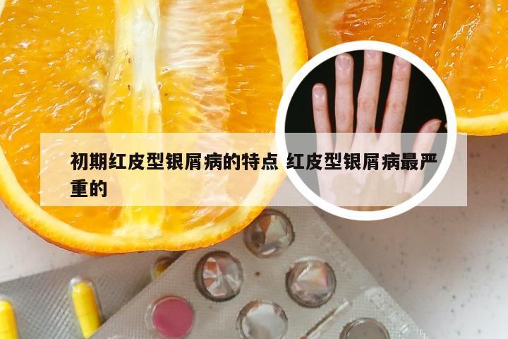 初期红皮型银屑病的特点 红皮型银屑病最严重的