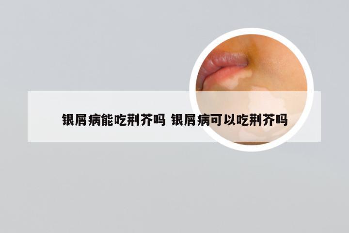 银屑病能吃荆芥吗 银屑病可以吃荆芥吗