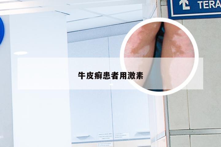 牛皮癣患者用激素