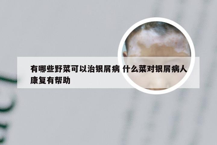 有哪些野菜可以治银屑病 什么菜对银屑病人康复有帮助