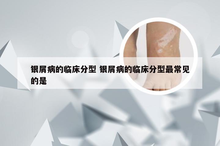 银屑病的临床分型 银屑病的临床分型最常见的是