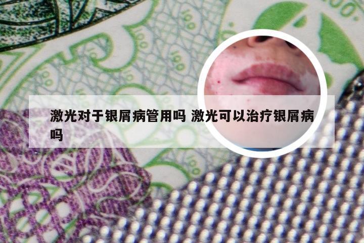 激光对于银屑病管用吗 激光可以治疗银屑病吗