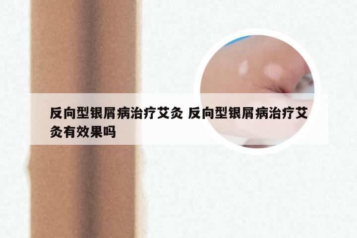 反向型银屑病治疗艾灸 反向型银屑病治疗艾灸有效果吗