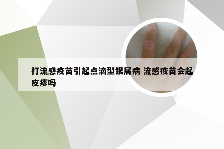 打流感疫苗引起点滴型银屑病 流感疫苗会起皮疹吗