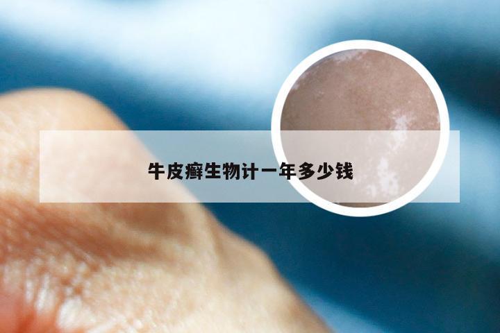 牛皮癣生物计一年多少钱