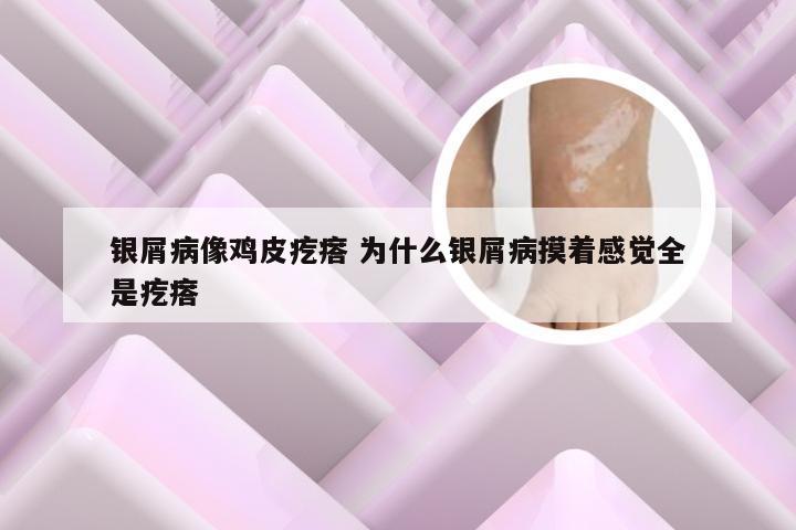 银屑病像鸡皮疙瘩 为什么银屑病摸着感觉全是疙瘩