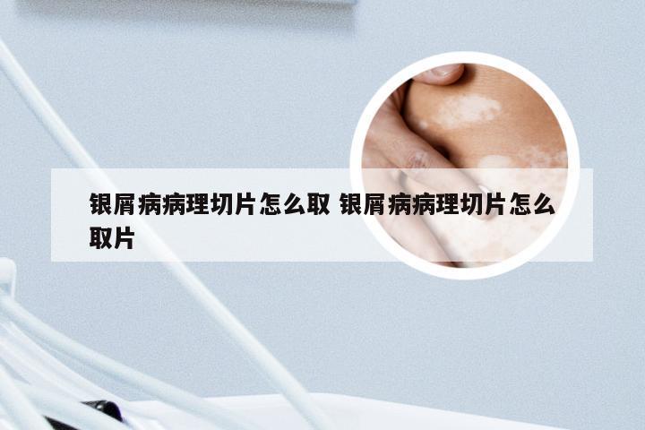 银屑病病理切片怎么取 银屑病病理切片怎么取片