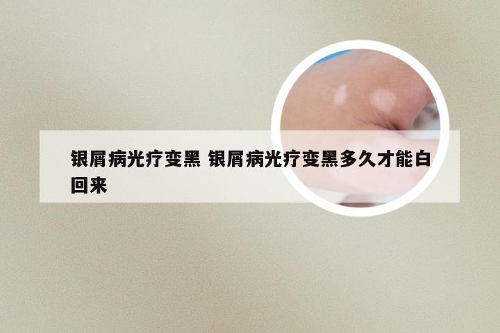 银屑病光疗变黑 银屑病光疗变黑多久才能白回来