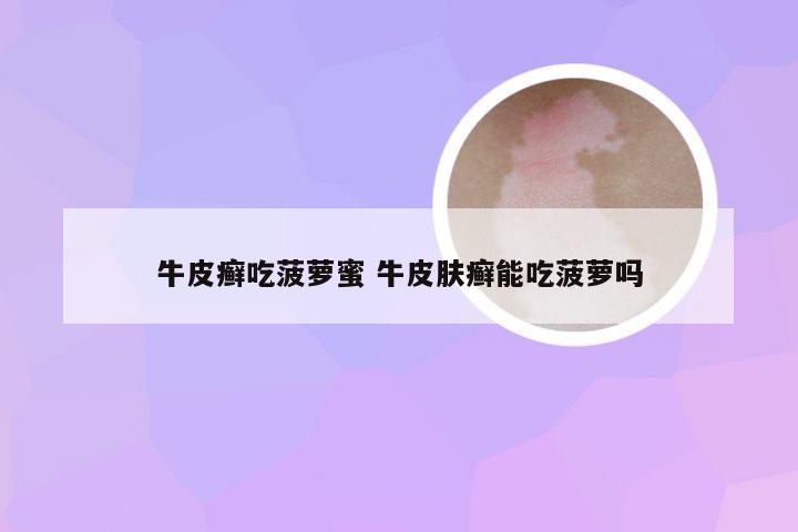 牛皮癣吃菠萝蜜 牛皮肤癣能吃菠萝吗