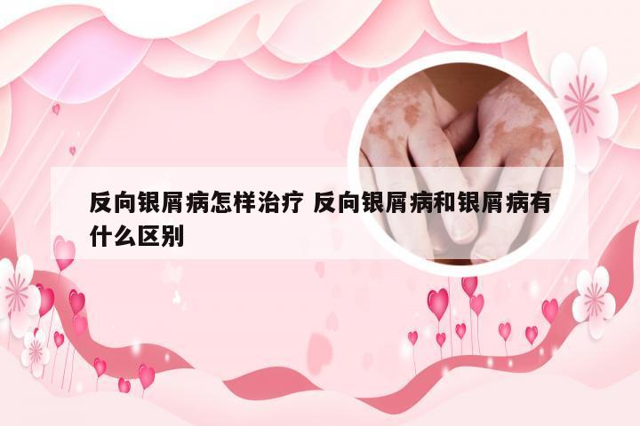 反向银屑病怎样治疗 反向银屑病和银屑病有什么区别