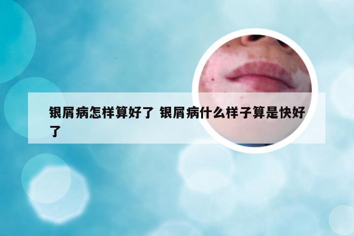 银屑病怎样算好了 银屑病什么样子算是快好了