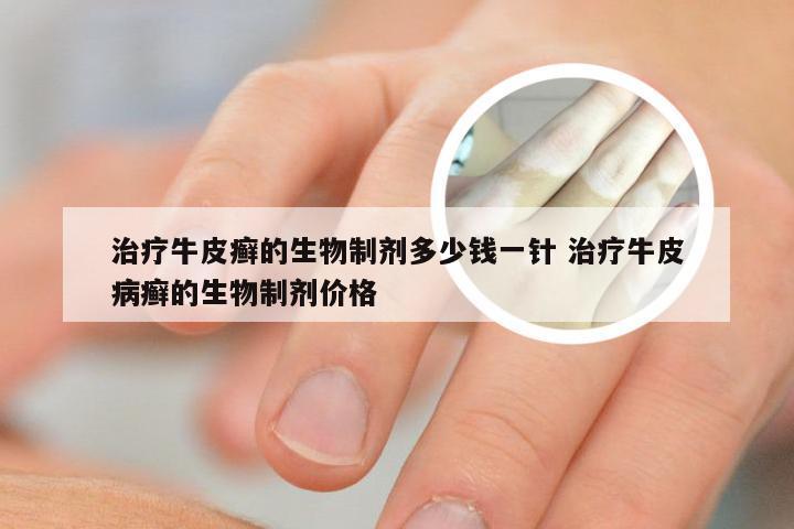 治疗牛皮癣的生物制剂多少钱一针 治疗牛皮病癣的生物制剂价格