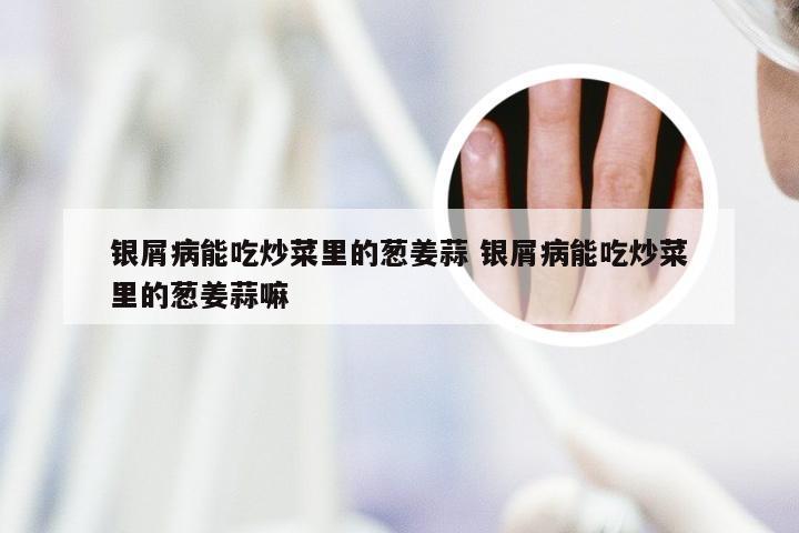 银屑病能吃炒菜里的葱姜蒜 银屑病能吃炒菜里的葱姜蒜嘛