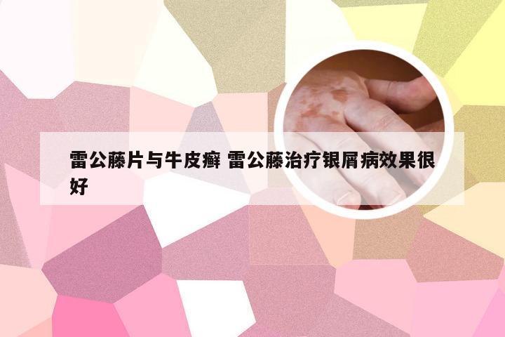 雷公藤片与牛皮癣 雷公藤治疗银屑病效果很好