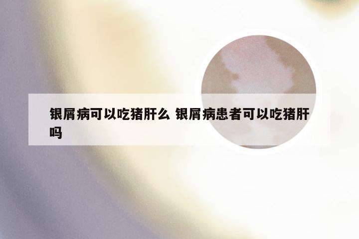 银屑病可以吃猪肝么 银屑病患者可以吃猪肝吗