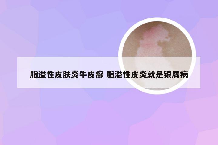 脂溢性皮肤炎牛皮癣 脂溢性皮炎就是银屑病