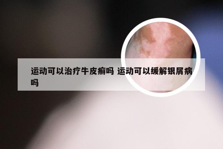 运动可以治疗牛皮癣吗 运动可以缓解银屑病吗