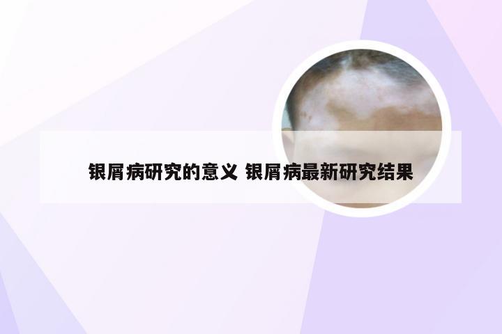 银屑病研究的意义 银屑病最新研究结果