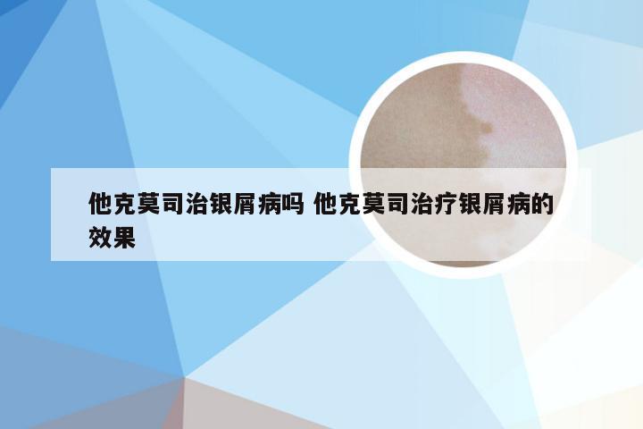 他克莫司治银屑病吗 他克莫司治疗银屑病的效果