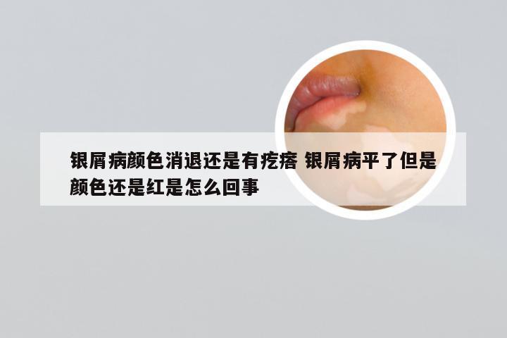 银屑病颜色消退还是有疙瘩 银屑病平了但是颜色还是红是怎么回事