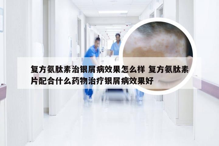 复方氨肽素治银屑病效果怎么样 复方氨肽素片配合什么药物治疗银屑病效果好