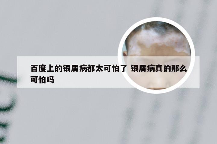 百度上的银屑病都太可怕了 银屑病真的那么可怕吗