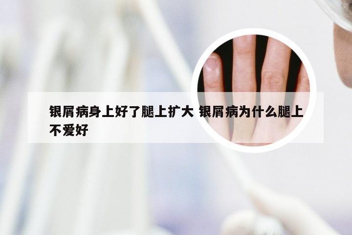 银屑病身上好了腿上扩大 银屑病为什么腿上不爱好