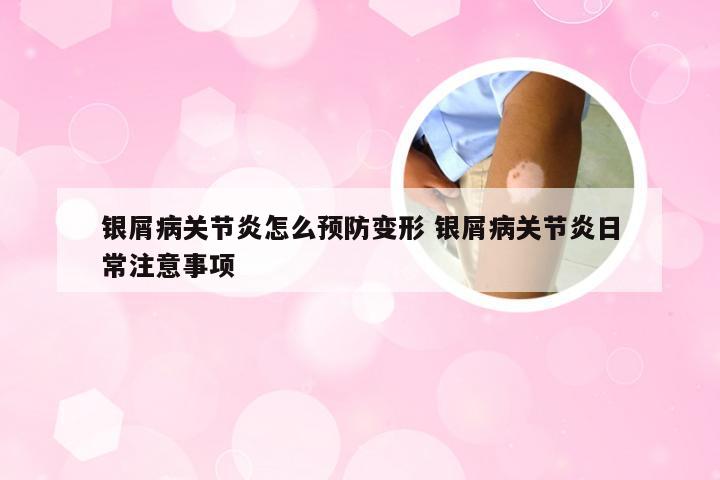 银屑病关节炎怎么预防变形 银屑病关节炎日常注意事项