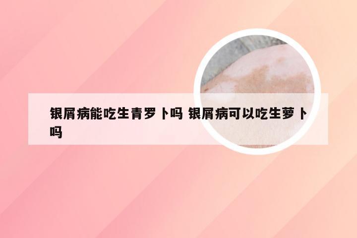 银屑病能吃生青罗卜吗 银屑病可以吃生萝卜吗