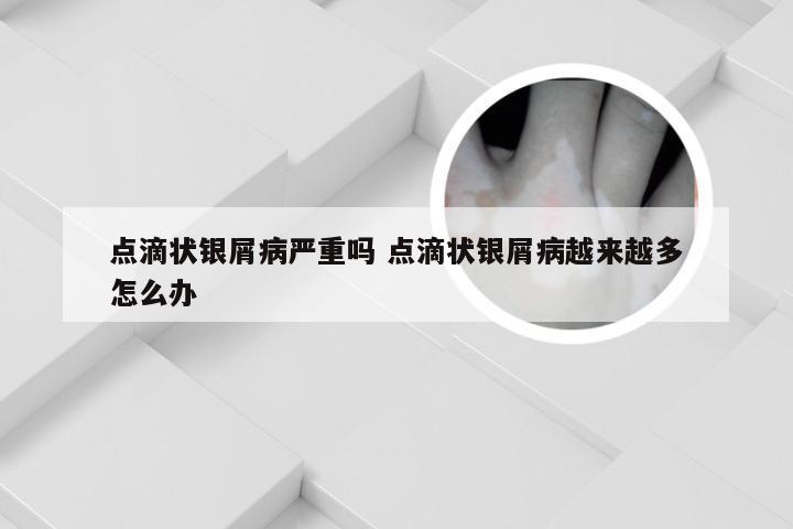 点滴状银屑病严重吗 点滴状银屑病越来越多怎么办