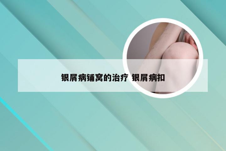 银屑病铺窝的治疗 银屑病扣