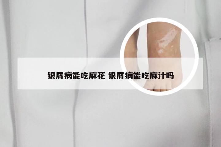 银屑病能吃麻花 银屑病能吃麻汁吗