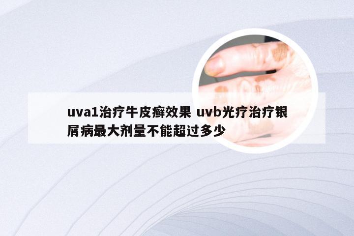 uva1治疗牛皮癣效果 uvb光疗治疗银屑病最大剂量不能超过多少