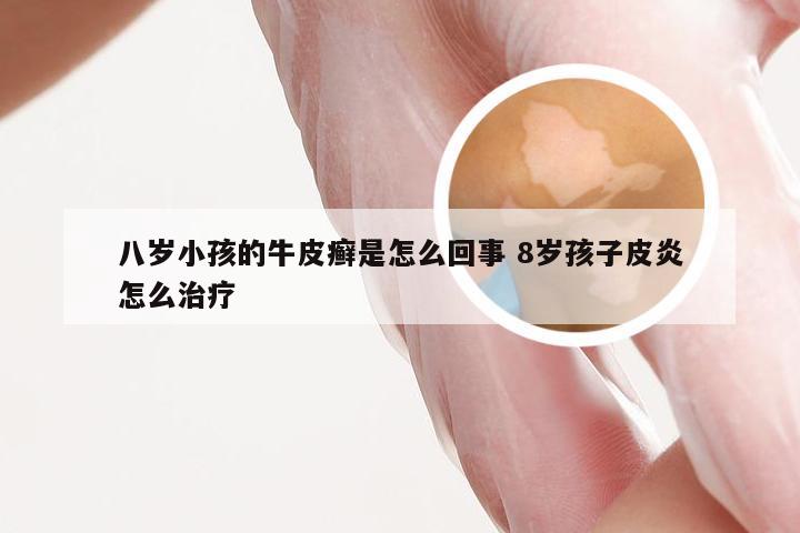 八岁小孩的牛皮癣是怎么回事 8岁孩子皮炎怎么治疗