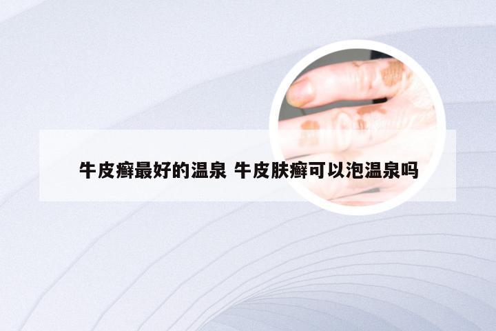 牛皮癣最好的温泉 牛皮肤癣可以泡温泉吗