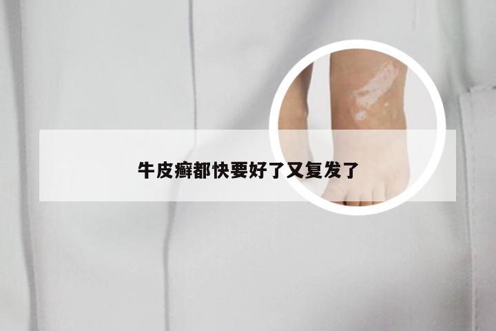 牛皮癣都快要好了又复发了