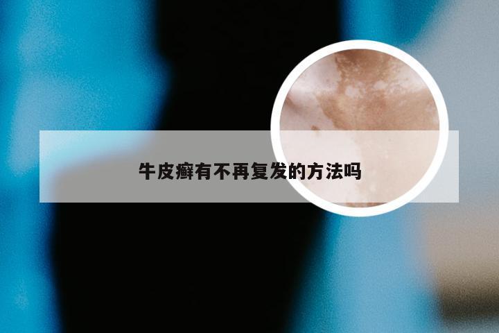 牛皮癣有不再复发的方法吗