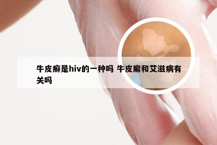 牛皮癣是hiv的一种吗 牛皮廨和艾滋病有关吗
