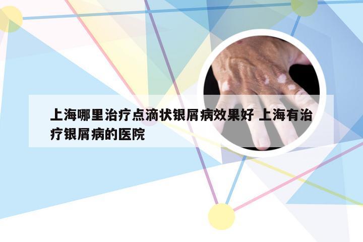 上海哪里治疗点滴状银屑病效果好 上海有治疗银屑病的医院