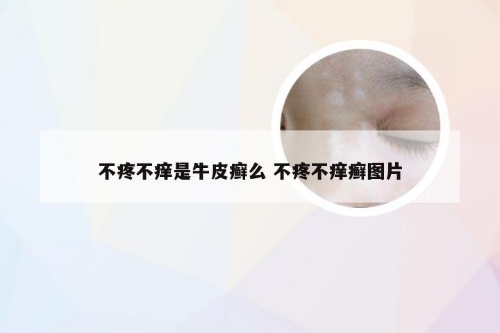 不疼不痒是牛皮癣么 不疼不痒癣图片