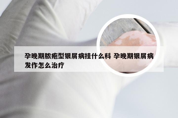 孕晚期脓疱型银屑病挂什么科 孕晚期银屑病发作怎么治疗