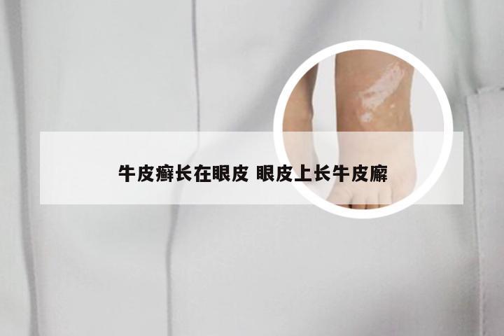 牛皮癣长在眼皮 眼皮上长牛皮廨