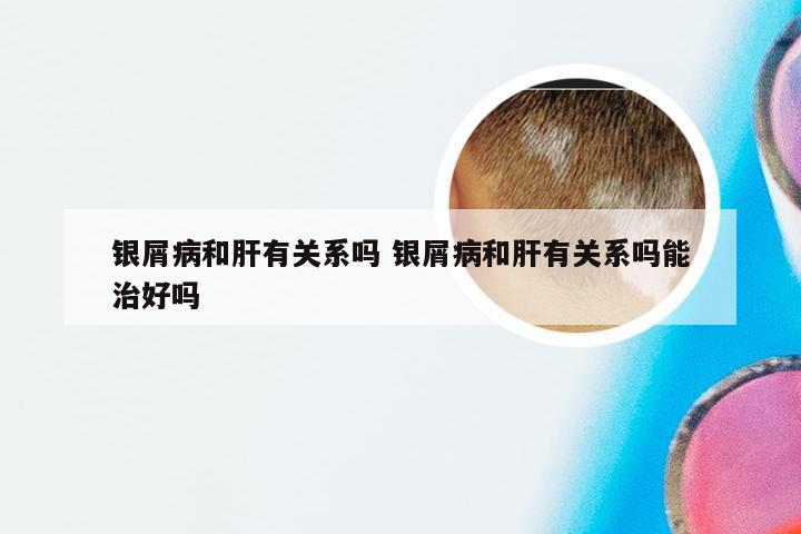 银屑病和肝有关系吗 银屑病和肝有关系吗能治好吗