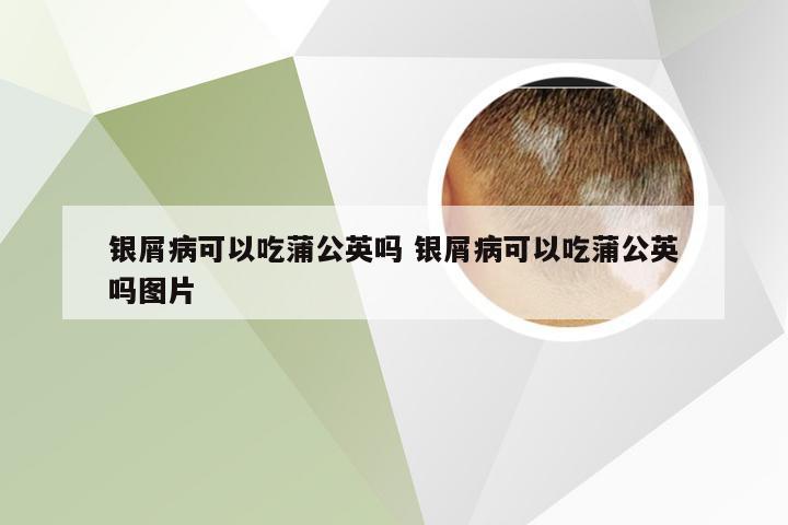 银屑病可以吃蒲公英吗 银屑病可以吃蒲公英吗图片