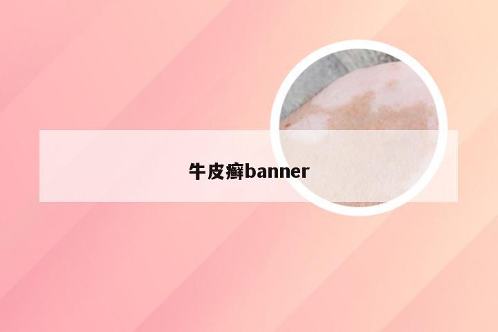 牛皮癣banner