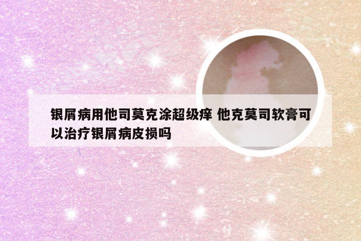 银屑病用他司莫克涂超级痒 他克莫司软膏可以治疗银屑病皮损吗