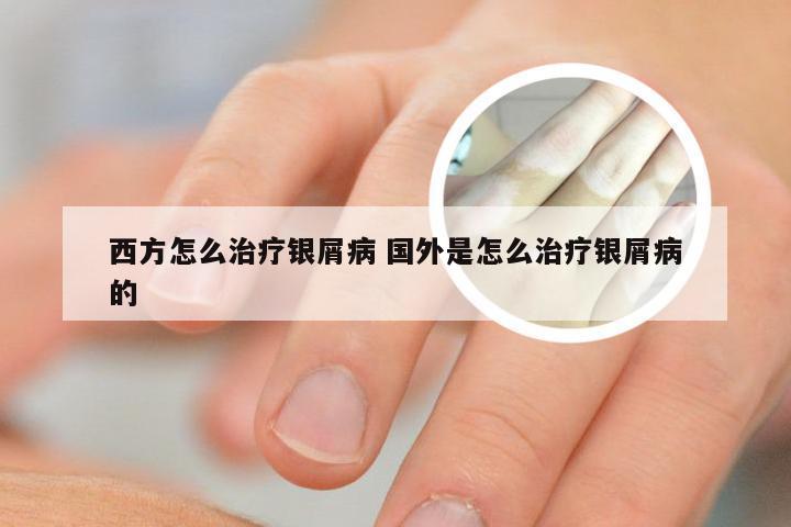 西方怎么治疗银屑病 国外是怎么治疗银屑病的
