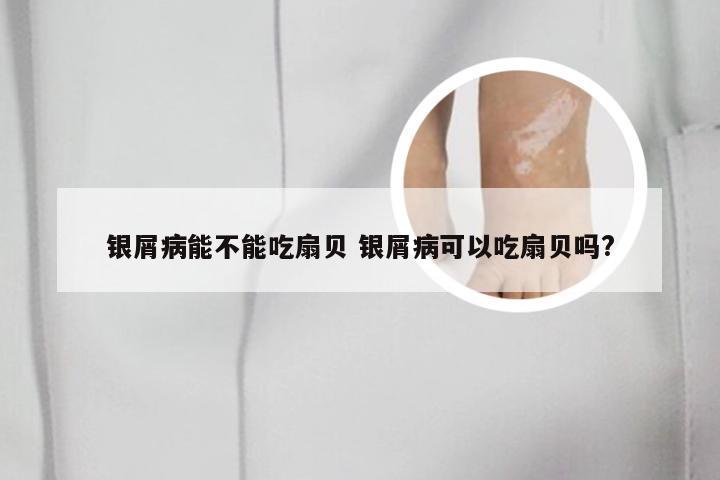 银屑病能不能吃扇贝 银屑病可以吃扇贝吗?
