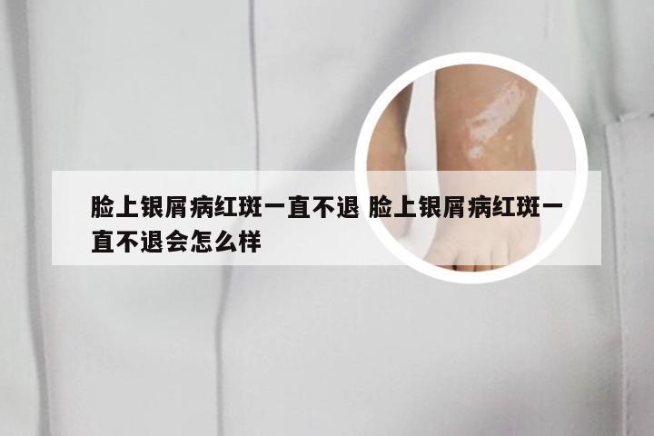 脸上银屑病红斑一直不退 脸上银屑病红斑一直不退会怎么样